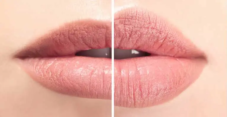 derma-fillers